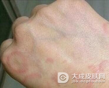 得了皮肌炎应该怎么办才好呢
