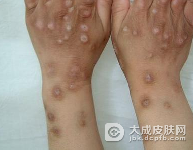 冬季痒疹应该怎么办呢