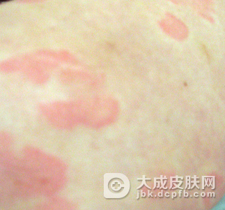 儿童脓包疮是怎么产生的呢