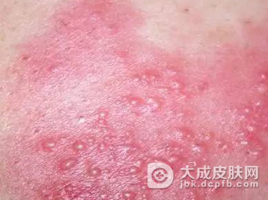 脓包疮是什么东西呢