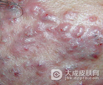 痤疮该怎样有效治疗