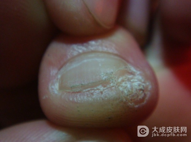 常见的甲沟炎的症状有哪些