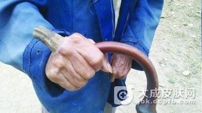 掌跖角皮病护理小常识