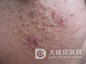 导致青春痘的病因都有什么