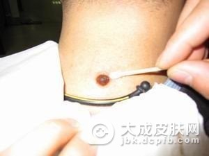 为什么会出现鲜红斑痣