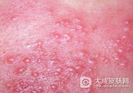 性交后服抗生素可防生殖器疱疹吗