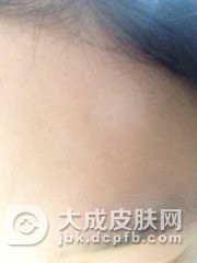 单纯糠疹早期有什么症状