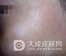 单纯糠疹有哪些症状
