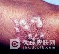 瘰疬性皮肤结核病的临床表现