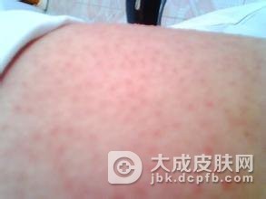 萎缩性毛周角化病的病因