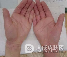 烟酸缺乏引起皱襞舌是什么