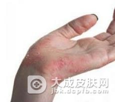 须癣毛癣菌引起的手癣是什么