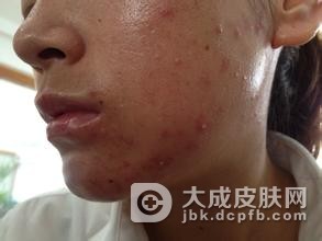 长青春痘吃什么好