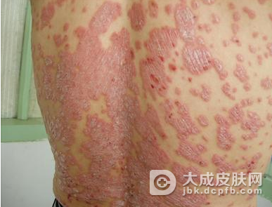 药物来治疗牛皮癣具体的都有哪些注意事项呢
