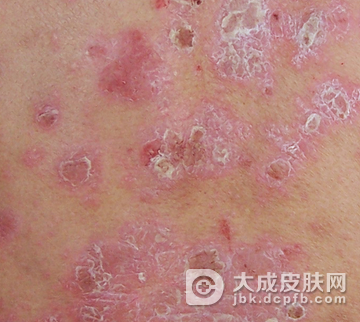 秋冬季晨练适合牛皮癣患者吗
