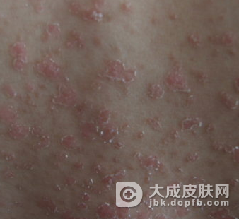 牛皮癣很难治愈吗