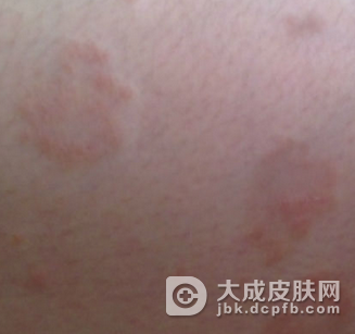 牛皮癣冬季保健的好处有哪些呢