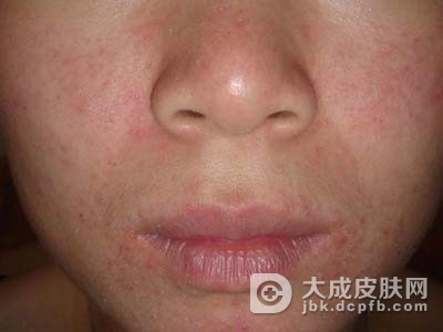 异位性皮炎需要做好哪些护理措施