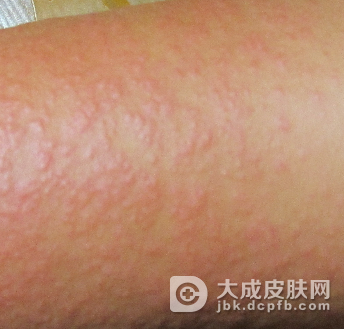 日光性皮炎平时应该如何进行预防呢