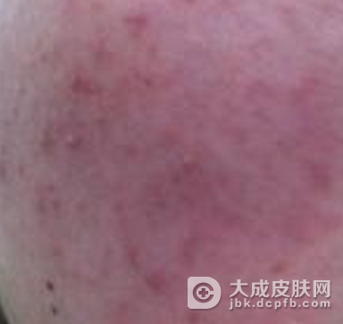 中医治疗日光性皮炎呢