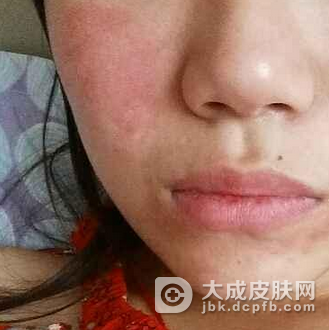 日光性皮炎不能够吃什么