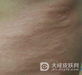 皮肤过敏患者的饮食要注意什么