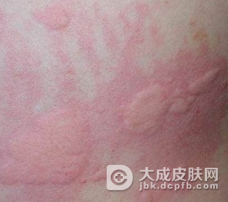 皮肤过敏在儿童的皮肤的表现是什么