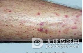 变应性皮肤血管炎病理改变