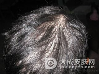 石棉状糠疹的诊断要点有哪些呢