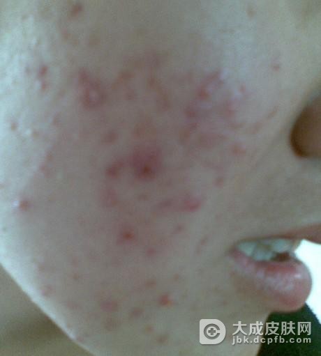过度的熬夜也会导致青春痘的