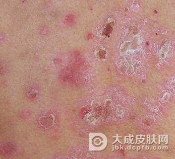 牛皮癣都有哪些我们不知道的危害