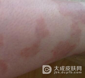 牛皮癣患者感冒了该怎么办