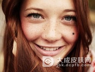 怎样预防黑色素痣