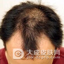 脱发治疗常见的误区有哪些呢