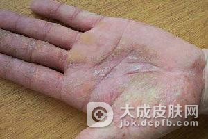 手足癣的爱心护理小贴士