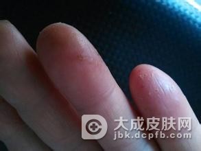 冻疮都有哪些常见症状呢