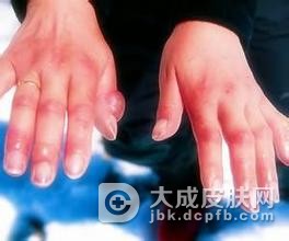 手指上的冻疮要如何治疗呢