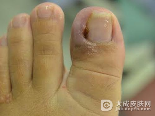 甲沟炎患者的饮食要点