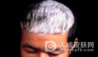 石棉状糠疹是一种怎样的病