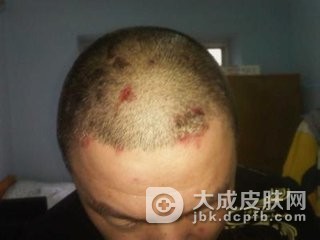 头皮石棉状糠疹与银屑病的区别是什么