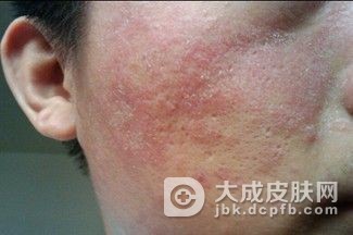 接触性皮炎护理措施你知多少