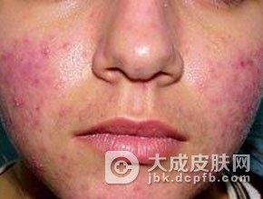 酒槽鼻有什么症状