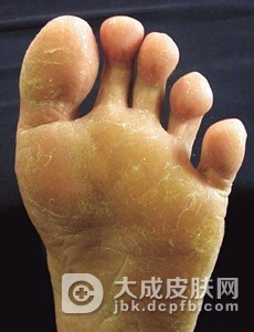 脚气应该如何预防