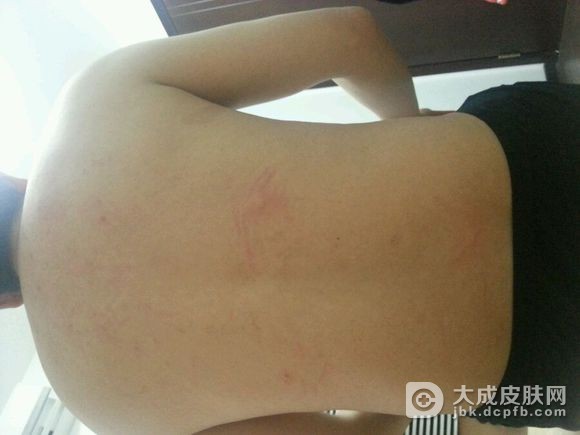 春夏季节要预防日光性荨麻疹