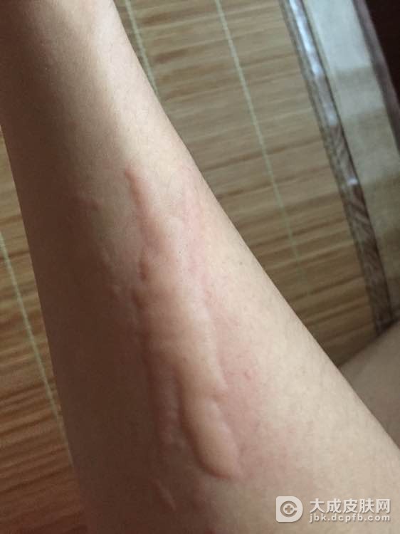 如何确诊日光性荨麻疹