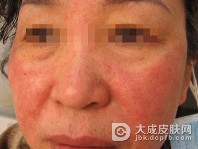 异位性皮炎皮炎的症状是什么