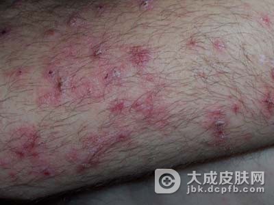 单纯痒疹的症状体征有哪些