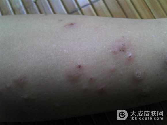 单纯性痒疹的治疗原理