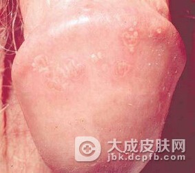 生殖器疱疹是性病吗