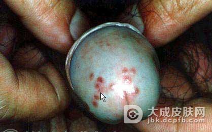 男性生殖器疱疹的症状